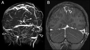 A major blood vessel called the jugular vein carries blood through the cavernous sinuses away from the brain. Acute Blindness Due To Cerebral Venous Sinus Thrombosis In A Child Postgraduate Medical Journal