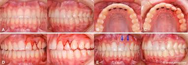 Traumatismes Dentaires Et Orthodontie Bucco