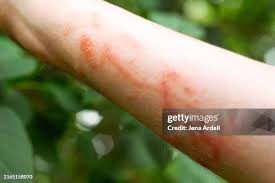 Image result for Rhus Dermatitis