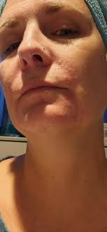 After having a flair up, does anyone else's skin peel off all the time ,  and foundation makeup looks cakey and doesn't look good