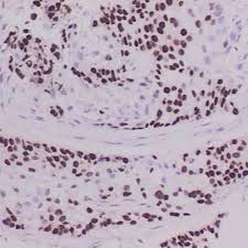 Expression Of Ttf 1 P63 In Lung Cancer Envision Two Step Method Download Scientific Diagram