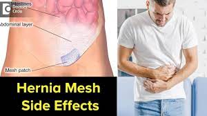 Can Hernia Mesh Cause Problems Years Later Signs Symptoms Treatment Dr Nanda Rajaneesh Youtube