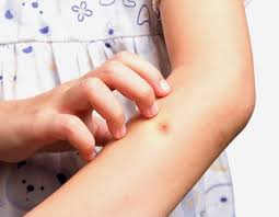 Socul anafilactic (reactie alergica severa) se poate instala de la o intepatura si poate cauza moartea in cazul in care. InÈ›epÄƒtura De AlbinÄƒ Sau Viespe 7 MÄƒsuri Pe Care SÄƒ Le Intreprinzi Imediat Ea Md