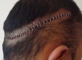 How Long After Hair Transplant Surgery Should Staples Be Removed Hair Transplant Hair Transplant Surgery Hair Transplant Procedure