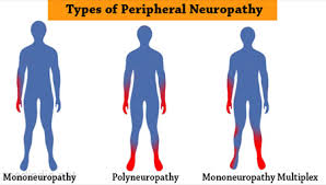 Image result for Peripheral Neuropathy