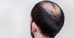 For the best results, gently massage the shampoo into your wet hair and scalp for one minute and then rinse thoroughly. Hair Replacement For Men Choosing The Best Hair System