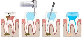 Maybe you would like to learn more about one of these? Endodontist Near Me No Insurance Ok Root Canal Specialist