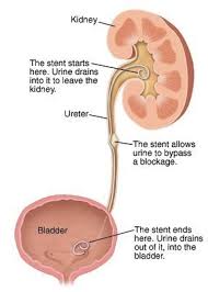 I Had This Done July 20 2017 Not Fun Kidney Failure Treatment Renal Calculi Medical Coding