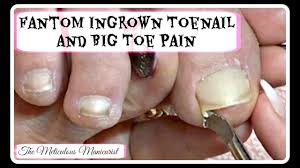 The only problem i still have is lifting. Ingrown Toenail Big Toe Pain Remedy Pedicure Tutorial Youtube
