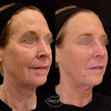 Full Facial Balancing is one of our signature treatments ⚖️ A customized  blend of filler and neuromodulator (Botox, Daxxify, etc.) designed to  restore youthfulness, structure, and harmony exactly where YOU need it!!!