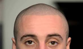 Scalp tattoos are usually worn by tattoo artists and tattoo collector, with their whole body covered. Hair Tattoo What Is Scalp Micropigmentation Cost Before After Pics