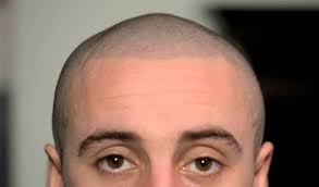 Hair loss has affected hundreds of men and women all around the world. Hair Tattoo What Is Scalp Micropigmentation Cost Before After Pics