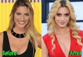 Lele Pons Before And After Nose Job Procedure Nose Job Lele Pons Nose Job Lele Pons Nose