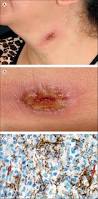 Image result for syphilis ulcer