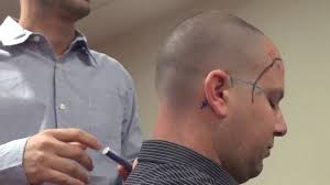 Yamamoto New Scalp Acupuncture 2020