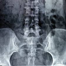 Image result for XRay Changes in Rheumatic Conditions