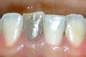 Med Bleaching Sanft Strahlend Schon Dr Hansen Munchen