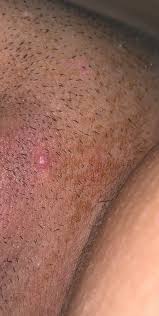 Hyperpigmentation may fade on its own over time. Herpes Or Ingrown Hair Genital Herpes Simplex Forums Patient