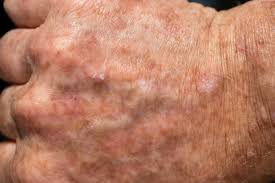 19.08.2011 · a form of keratosis that is considered precancerous is actinic keratosis. Actinic Keratosis Ocean Drive Dermatology Vero Beach