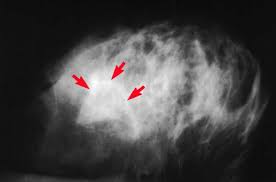 If a doctor is unsure of the cause of. Mammogram Images Normal And Abnormal