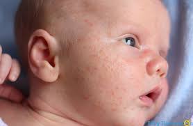 Olive oil is not recommended for babies with sensitive skin or skin allergies like eczema. 13 Most Amazing Benefits Of Figaro Olive Oil For Babies Massage Skin Hair