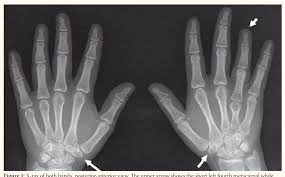Image result for Trapezoid Bone