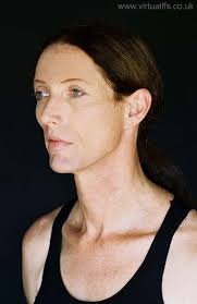 Facial Feminization Surgery and The Standards of Care