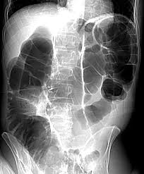 Image result for Sigmoid Volvulus