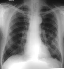Pleural plaques were not considered to be responsible for changes in lung . Calcified Pleural Plaques From Asbestos Exposure Radiology Case Radiopaedia Org