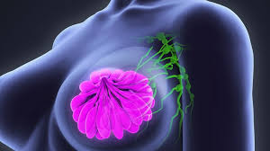Image result for breast cancer pictures