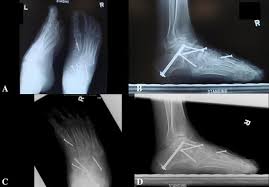 Club foot is usually diagnosed after a baby is born, although it may be spotted in pregnancy during the routine ultrasound scan carried out between 18. Case Report Correction Of Neglected Club Foot Deformity By Arthroscopic Assisted Triple Arthrodesis Springerlink