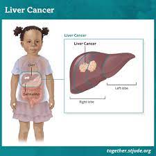 The most common type is adenocarcinoma and it often spreads or metastasizes. Liver Cancer In Children And Teens Together