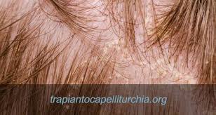La perdita dei peli di barba, ascelle, ciglia o sopracciglia può essere collegata a quella dei capelli solo quando si è in presenza . Dermatite Seborroica E Perdita Dei Capelli Cosa Fare Trapianto Capelli Turchia