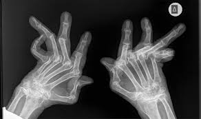 Image result for XRay Changes in Rheumatic Conditions