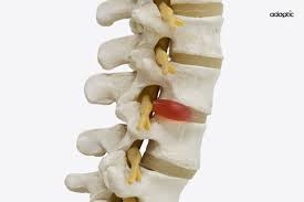 Image result for vyhřezlá ploténka