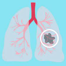 Lung cancer symptoms in babies : Lung Cancer Overview And More