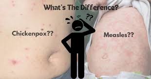 Image result for measles