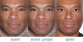 Les mots ont un sens. Rhinoplastie Pour Nez Crez Ou Ensellure Nasale A Paris