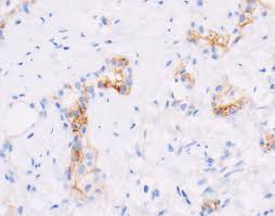 Epithelioid malignant mesothelioma pathology outlines. Pathology Outlines Diffuse Malignant Mesothelioma