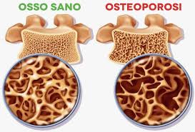 Calcio e vitamina d, ma anche proteine: Alimentazione Per Ossa Sane Archivi 360 Gradi Eventi