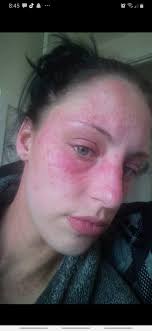 Highly Sensitive Skin Support Group