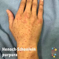 When to visit a doctor? Henoch Schonlein Purpura Skin Deep