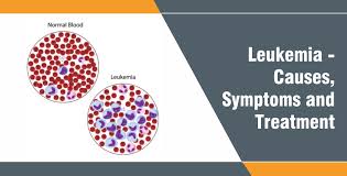 Chronic leukemia progresses more slowly, over months or. What Is Leukemia Causes Symptoms And Treatment Dr Rela Institute Chennai