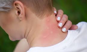 Tantarii sunt unele dintre cele mai periculoase daunatoare. Metode Naturale De A Tine Tantarii La Distanta Sigur Nu Dai Gres Kanal D Romania