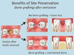 Hootsuite Bone Grafting Dental Implants Tooth Extraction Aftercare