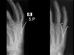 Boksor Kirigi 5 Metakarp Distal Uc Kirigi Istanbul Elcerrahisi