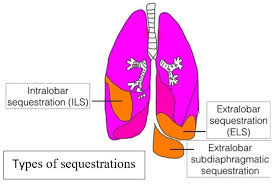 Découvrez le numéro de téléphone cpam ainsi que toutes les informations associées (horaires pour un numéro de téléphone cpam. What Is Lung Malformation In Children Causes Symptoms Treatment In Malaysia
