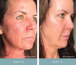IPL Laser Burns Before + After NeoGenesis Recovery Serum