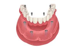 Some dentists even offer free restorative services like dentures every so often to give back to the community, like this dentist in las cruces, new mexico. Can I Get Dental Implants At A Dental School