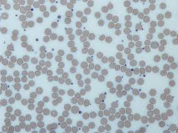 Image result for Platelet Function Closure Time